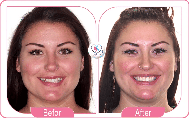 مراحل تجربتي مع تقويم الأسنان