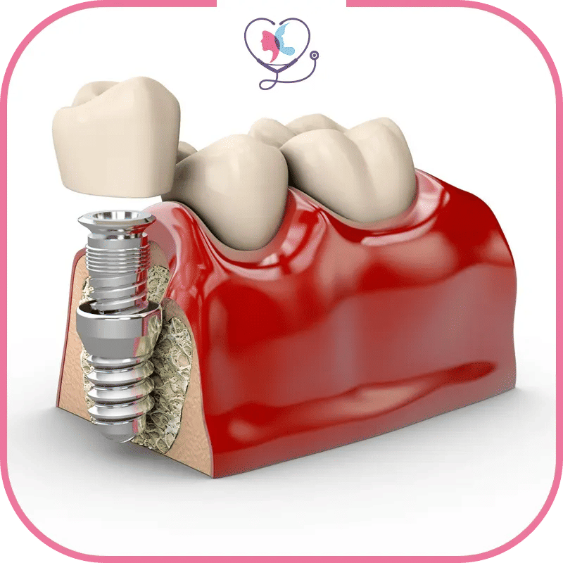 La procédure d'implant dentaire