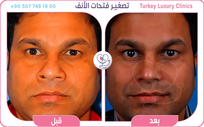 تصغير فتحات الانف بدون جراحه