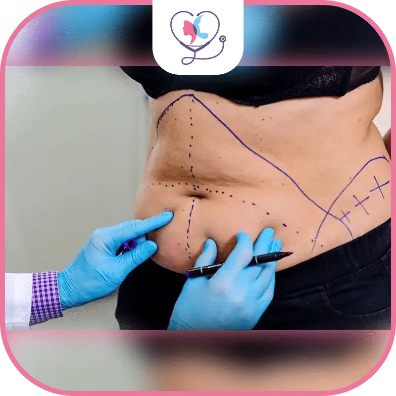 أضرار عملية شد البطن