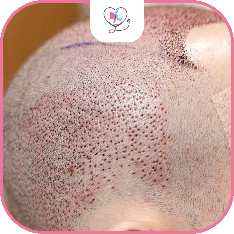 هل زراعة الشعر تؤثر على الإنجاب؟