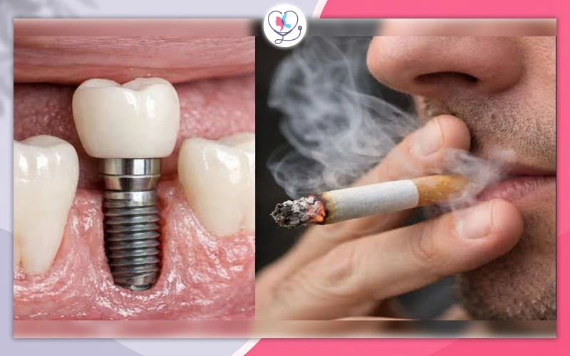 Can Smokers Get Dental Implants?
