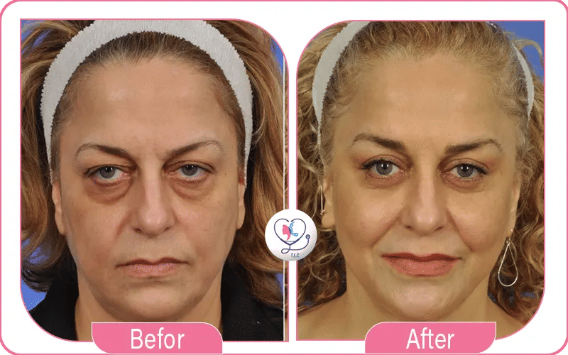 Qu’est-ce que la blépharoplastie au laser ?