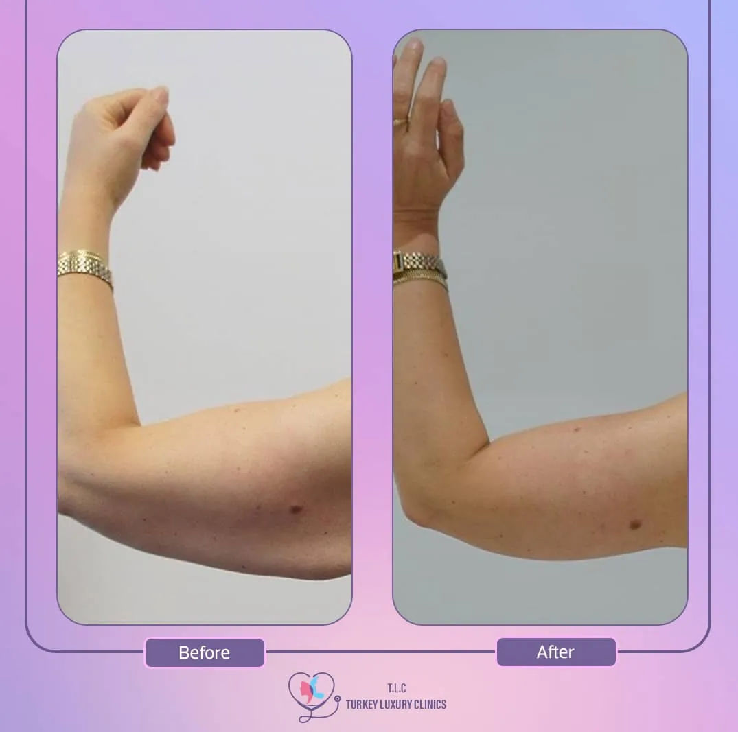 خطوات تجربتي مع عملية شد الذراعين