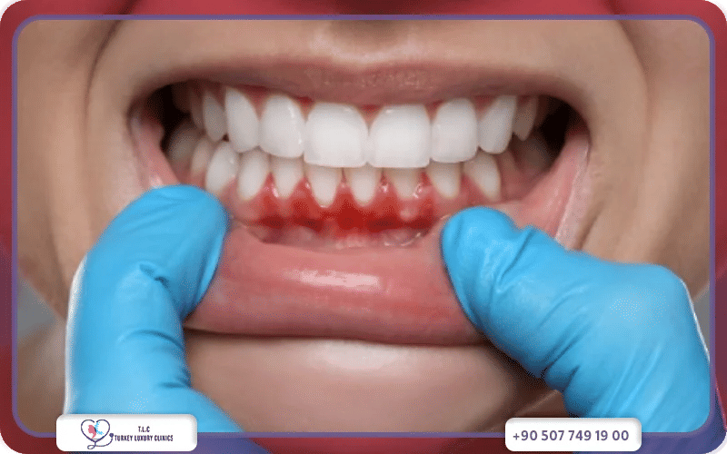 علاج نزيف اللثة مع تركيا لاكشري كلينك