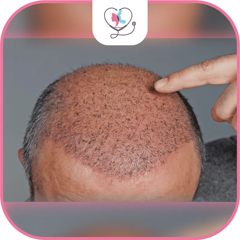 How to Prevent Shock Loss After Hair Transplant?