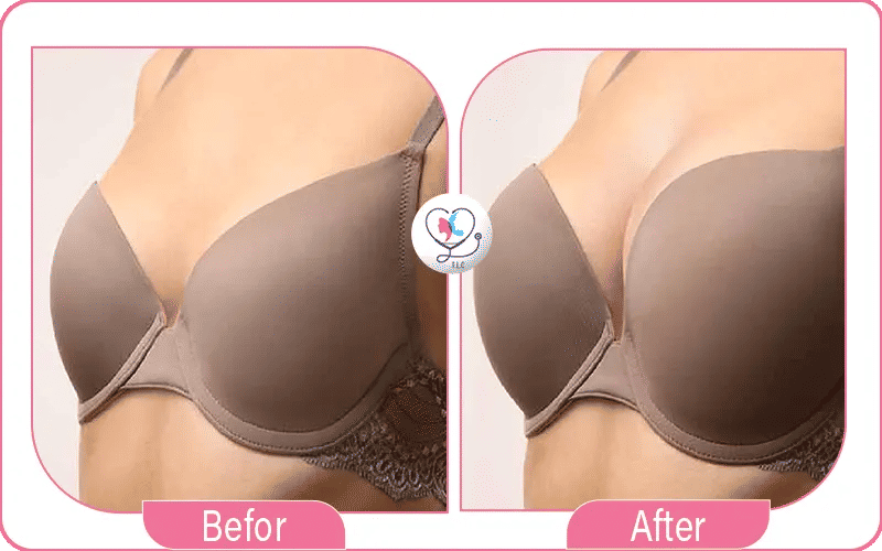 أولاً: قرار إجراء تجربتي في شد الثدي بالليزر