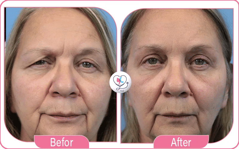 قرار شد الجفون مع تركيا لاكشري كلينك