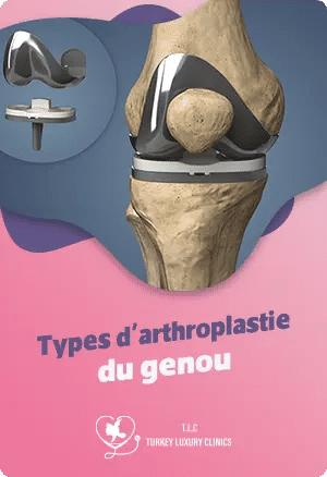 Types d'arthroplastie du genou