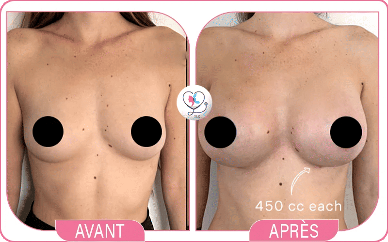 Résultats avant/après avec des implants de 450cc