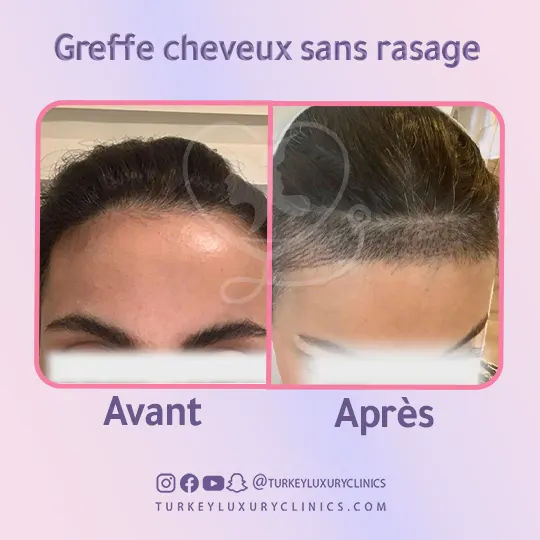 geffe cheveux sans rasage avant après