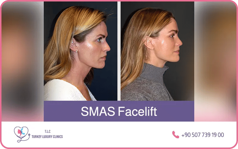 Lifting facciale SMAS in Turchia prima e dopo – risultati di tensionamento facciale naturale presso Turkey Luxury Clinics Istanbul
