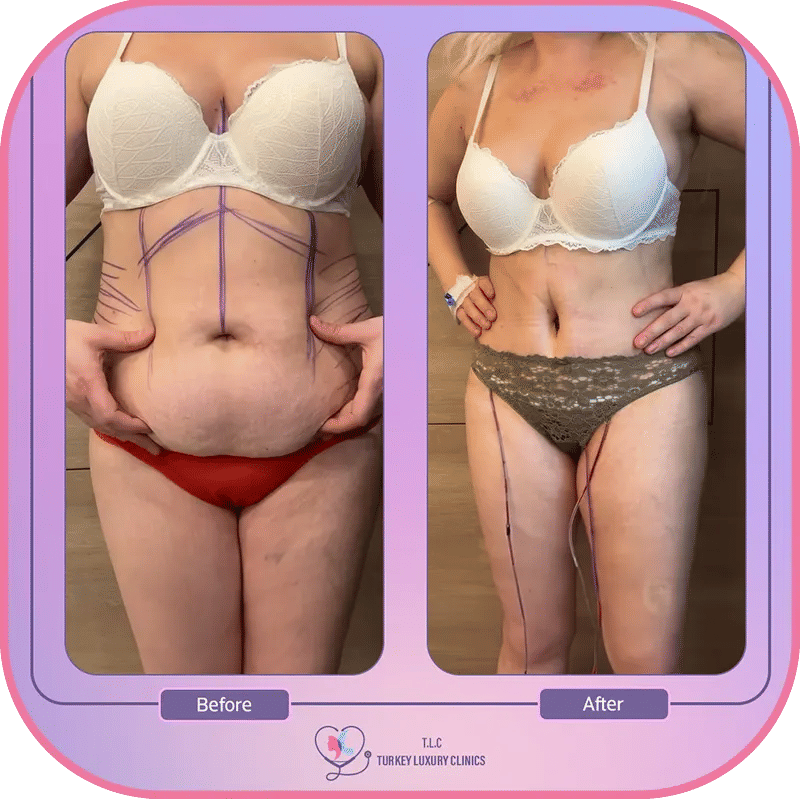 Can You Get a Gastric Sleeve as a Revision Surgery?