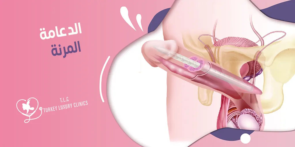 الدعامة المرنة: المميزات والعيوب والأسعار