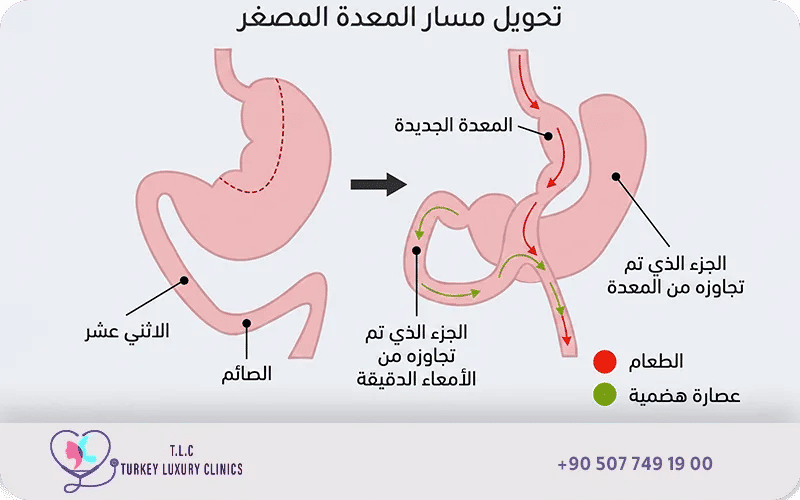 عملية تحويل مسار مُصغّر