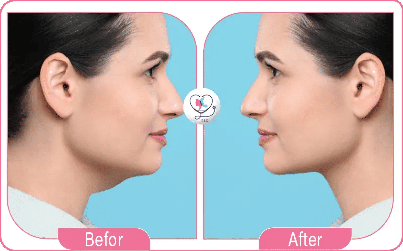 ثانياً: مريم "تجربتي مع شفط اللغلوغ بالليزر"