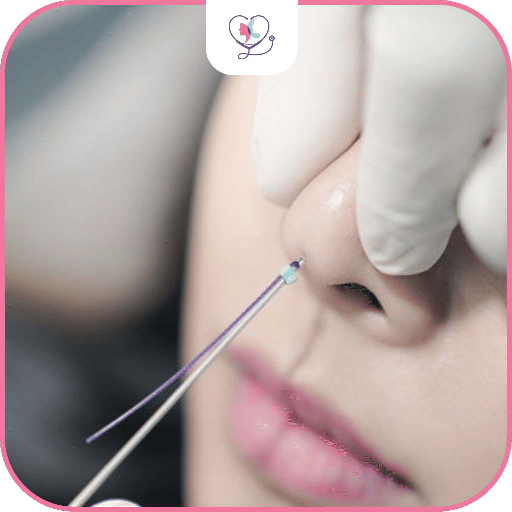 دواعي إجراء تجميل الأنف بالخيوط 