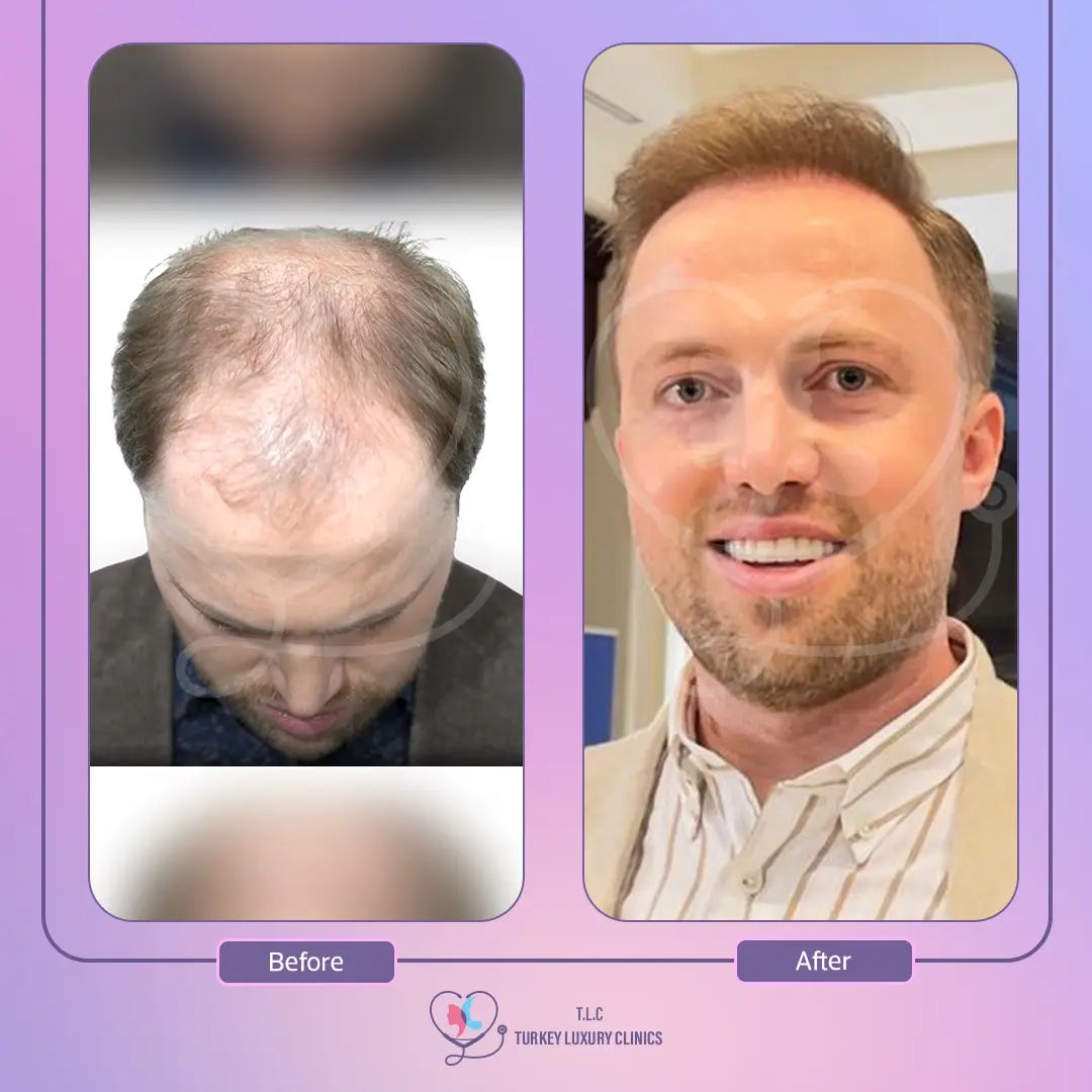 coût greffe de cheveux istanbul en Turquie 2025