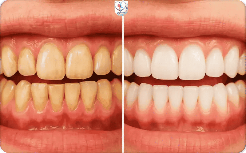 نصائح إزالة جير الأسنان تجربتي الناجحة