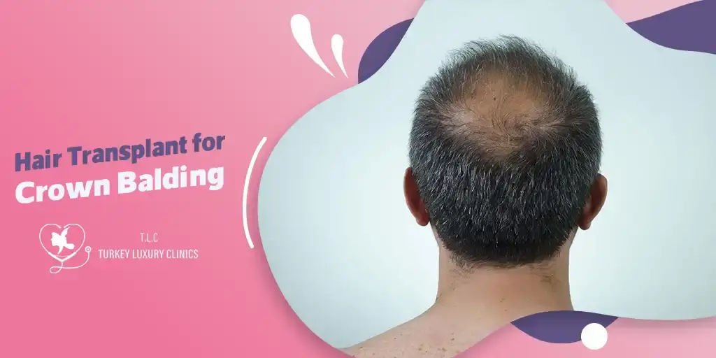 Haartransplantation bei Scheitelglatze: Lösungen und Ergebnisse