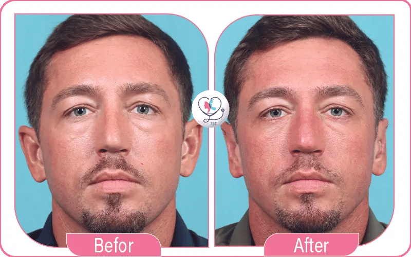 What is Incisionless Otoplasty?
