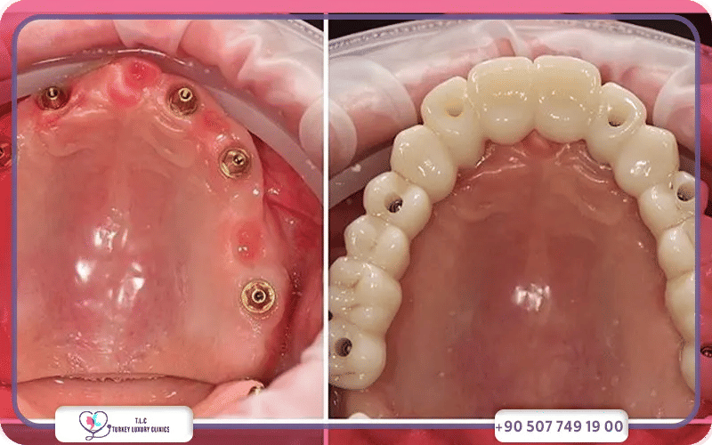 Combien coûte un traitement All-on-6 en moyenne ?