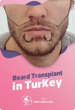 Beard Transplant in Turkeyfeatured image