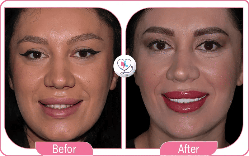 تبييض الاسنان بالليزر قبل وبعد