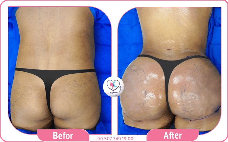 Photos shows round, lifted, and proportionate buttocks after BBL 