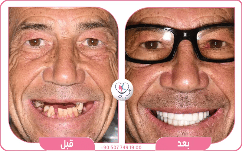 عيوب زراعة الأسنان