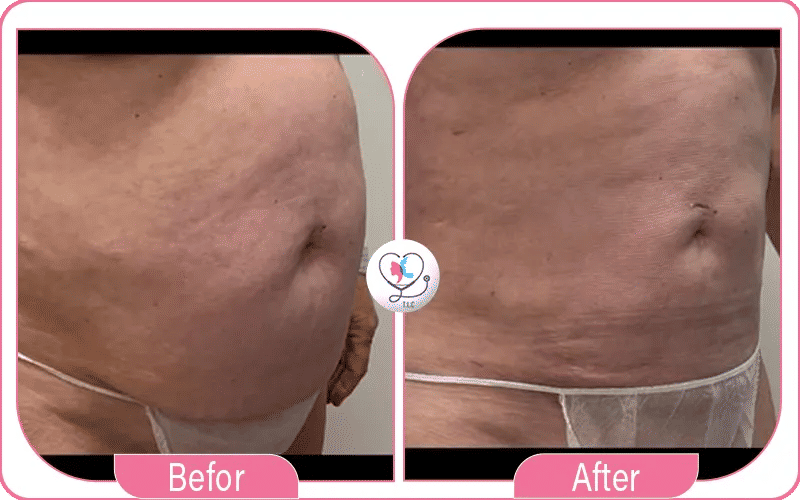 Vaser Liposuction in Turkey Before and After 2