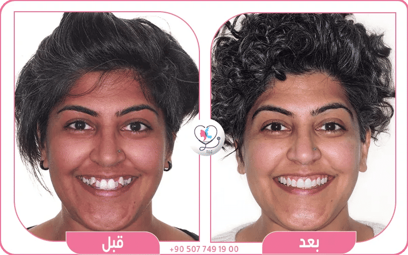 لتقويم الشفاف قبل وبعد