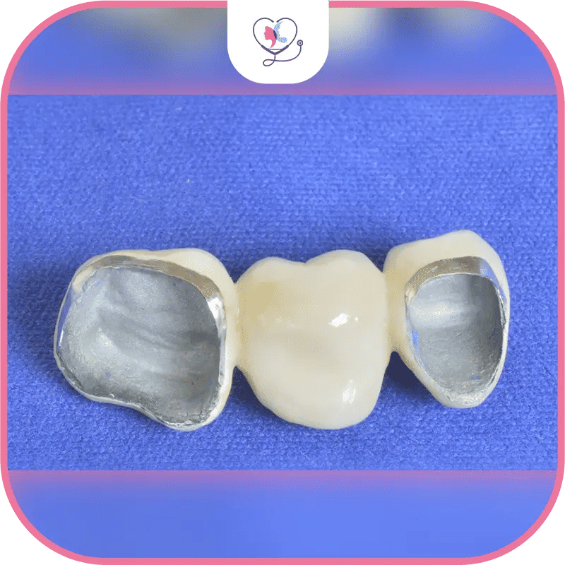 Types de matériaux métalliques pour bridges dentaires