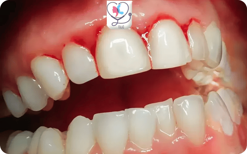 هل نزيف اللثة دليل على سرطان الدم؟