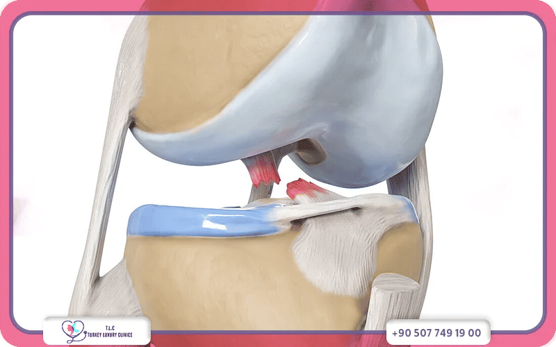 قطع الرباط الصليبي