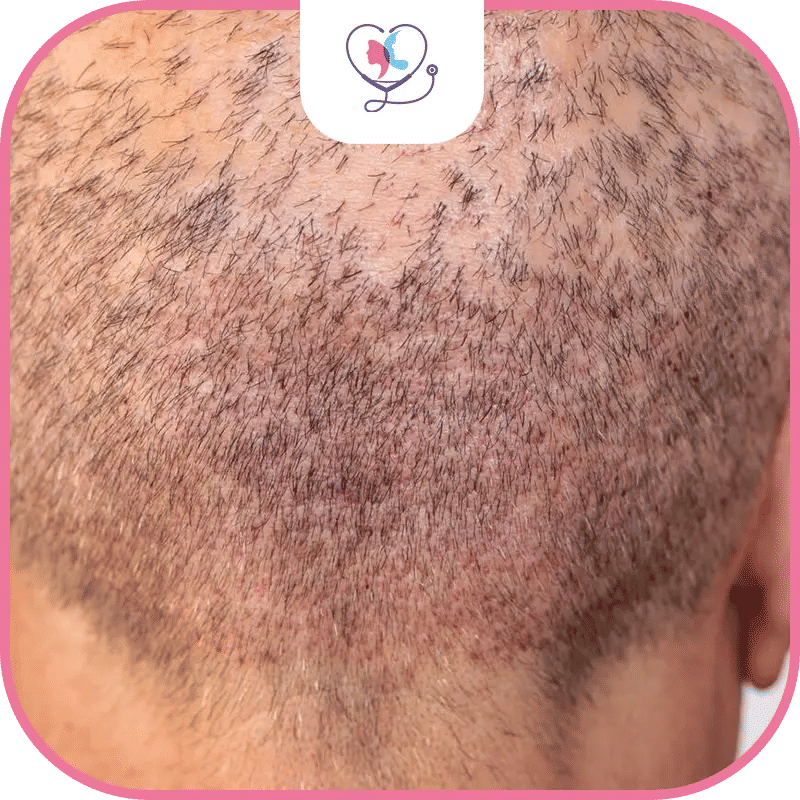 complications-de-la-greffe-de-cheveux