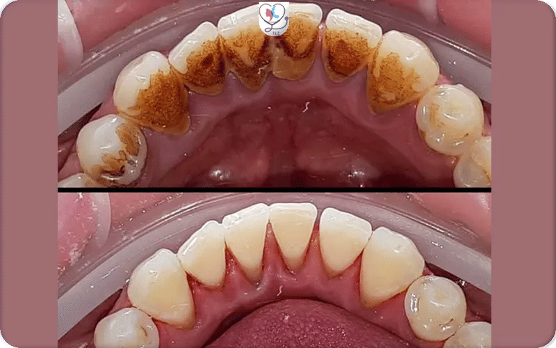 ماذا تشعر خلال إجراء جلسات إزالة جير الأسنان؟