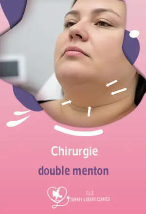 Chirurgie double menton : techniques, résultats & prix