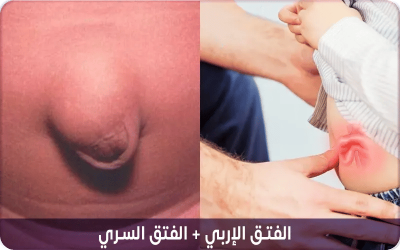 أنواع الفتق عند الاطفال