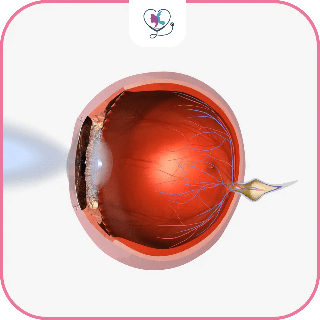 ماهي القرنية؟