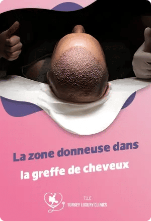 La zone donneuse dans la greffe de cheveux