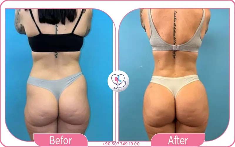 Factors affecting BBL Turkey prices