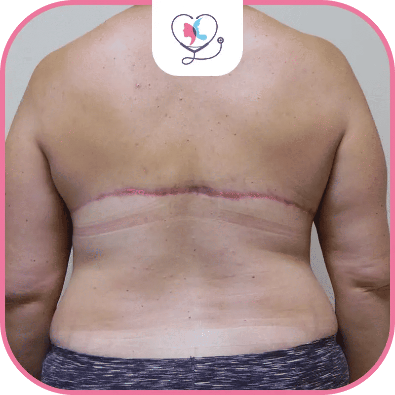 التعافي بعد عملية شد الظهر