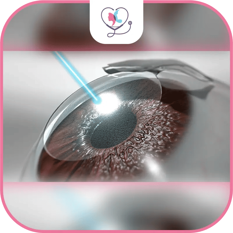 خطوات عملية الليزك