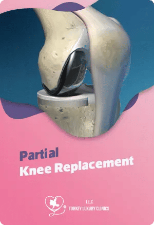 Partial Knee Replacement (PKR): The Full Guidefeatured image