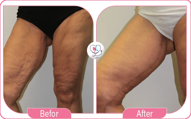 نتائج تجربتي في عملية شد ترهلات الفخذين