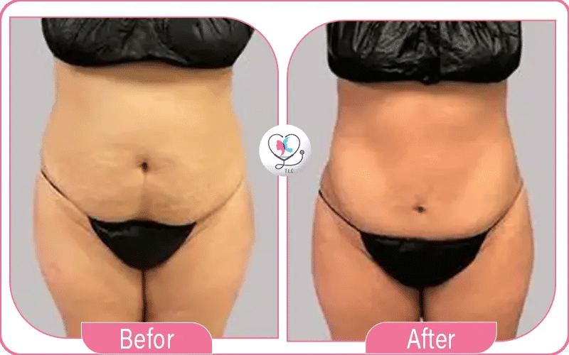 ثانياً: أثناء العملية