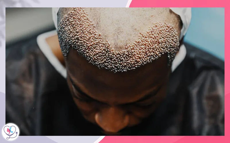 2000 Grafts Cost by Technique 