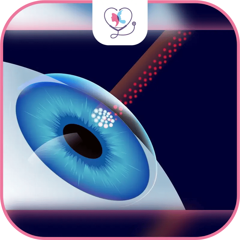 عملية الليزك قبل وبعد