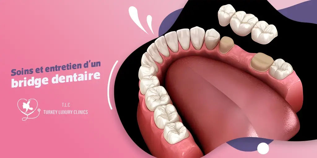 Soins et entretien d'un bridge dentaire